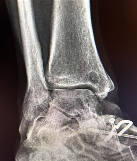 Capital Foot & Ankle Surgeons of Austin - ORIF Weber C Ankle fracture #