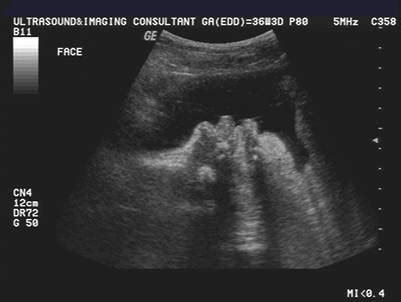 Macroglossia