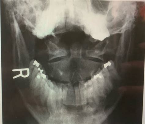 Pht Exam Cervical Spine Tmj Thoracic Lumbosacral Chest