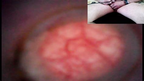 Look Inside Urethra And Bladder With Endoscope Gay Uncensored Porn Feat Lovesnow Xhamster