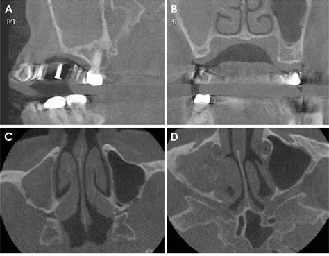 Figure 2 From A Case Report Of Incidental Finding Of Fungus Ball On