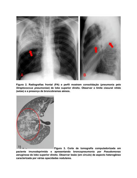 Solution Bases Radiologicas Das Doencas Toracicas Studypool