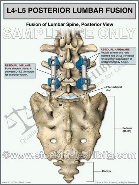 L4 L5 Lumbar Spine Fusion Posterior View Stock Trial Exhibits