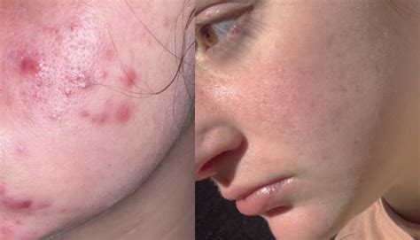 Accutane Before And After Cystic Acne