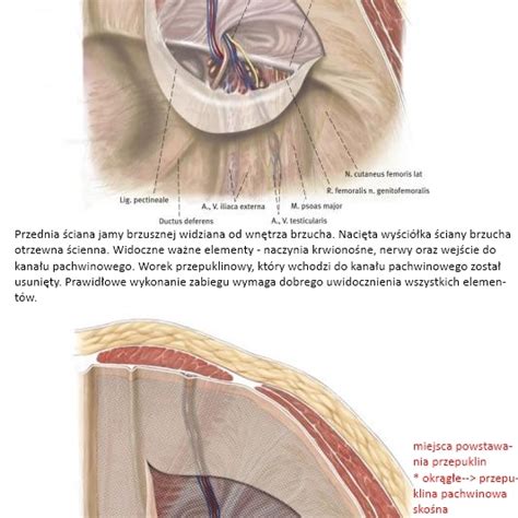 Szczegóły operacji przepuklin pachwiny Chirurgia przepuklin