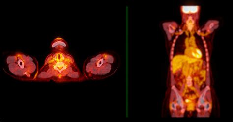 A Petct Scan Image Is A Diagnostic Visualization Combining Positron