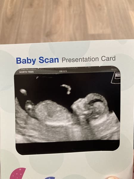 Anyone Want To Guess My Babys Gender From Scan Pic Mumsnet