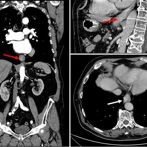 Ct Scan Of The Esophageal Mass Showing Asymmetrical Neoplastic Wall