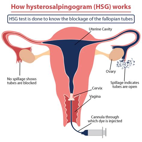 Histerosalpingografía todo lo que necesitas saber sobre esta prueba