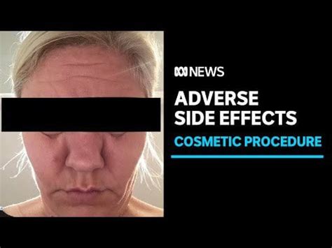 Patients report side effects after popular cosmetic procedure to ...