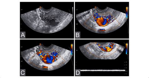 A 40 Year Old Female Patient Was Diagnosed With Uterine Arteriovenous