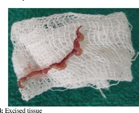 Figure 1 From Gingival Hyperplasia As An Emanation Of Wire And Braces