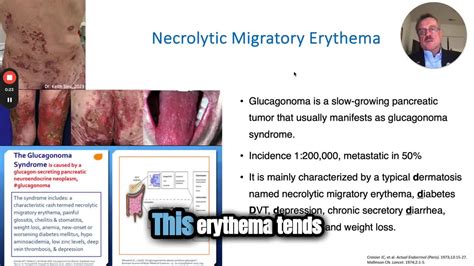 Endocollab™ Gi Endoscopy Education On Linkedin 👉 This Condition