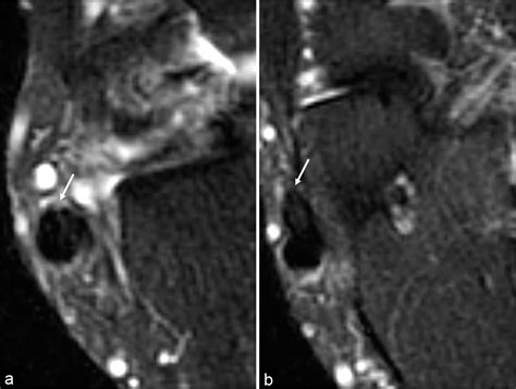 Improving pre-operative MRI diagnosis of peroneal tendon tears with a ...