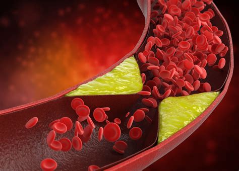 prevent arteriosclerosis key strategies  nutrition vegan lifestyle
