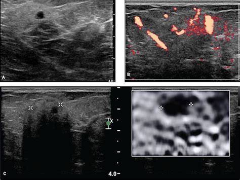 Mastitis Ultrasound