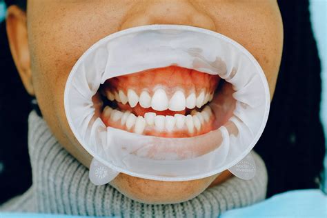 how much tooth is below the gum line 3