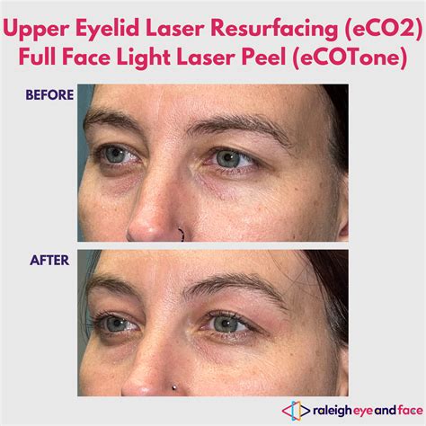 Laser Skin Resurfacing Before And After — Raleigh Eye And Face