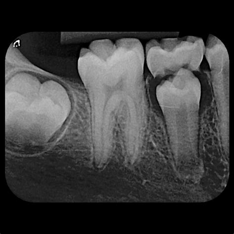 Raio X Periapical Valor - RADIOGRAFIA PERIAPICAL - UNIMAGEM