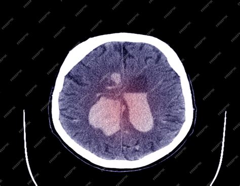 Tomografía Computarizada Ct O Cat Del Cerebro Para Descartar Un