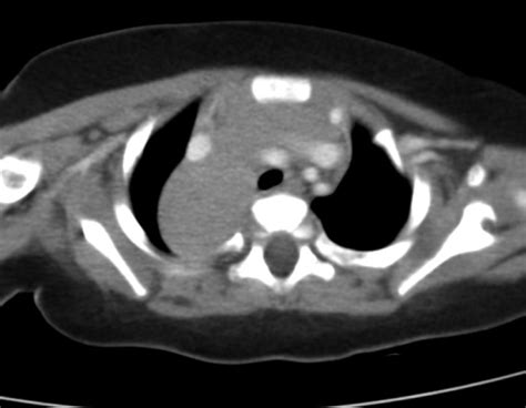 CT scan of chest illustrates a mass in the right posterior mediastinum ...