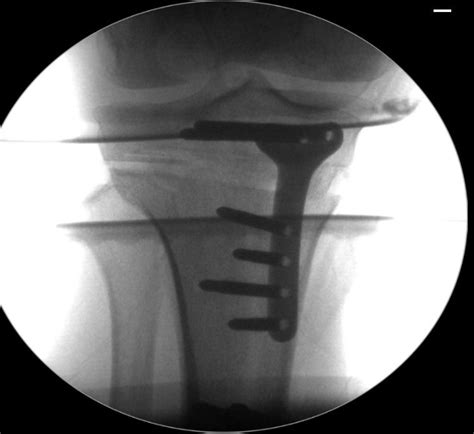 surgeons   cut   reshape  bones