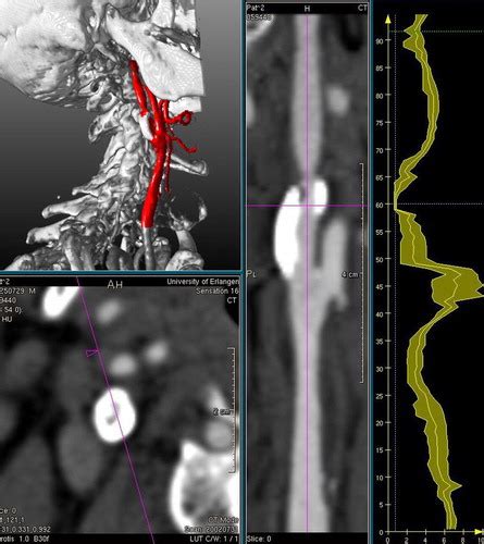 New Techniques In Ct Angiography Radiographics