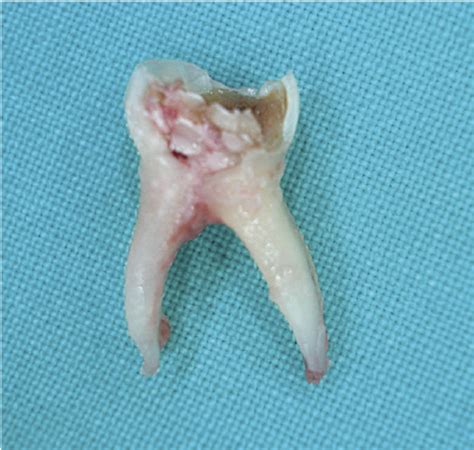 List Pictures Photos Of Infected Tooth Extraction Stunning