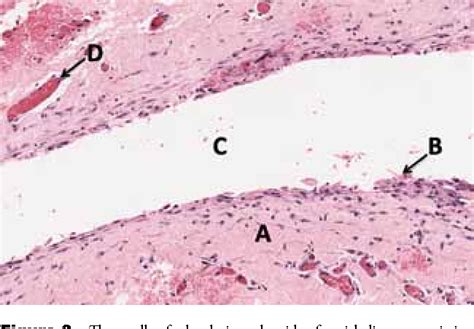 Ranula Histology