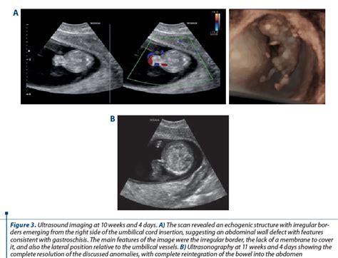 Ultrasound Based Differential Diagnosis Of Fetal Abdominal Wall Defects