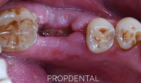 Descubre cómo se ve la encía después de una extracción dental y qué