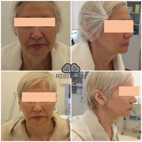 Нити Аптос для подтяжки лица (Aptos) в А Клинике: низкая цена в Москве ...