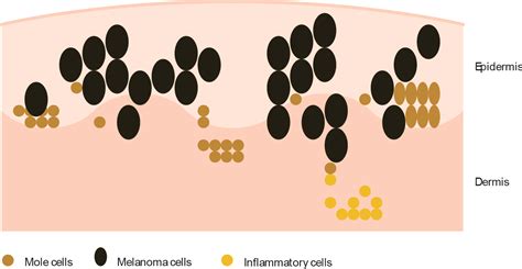 What Is Melanoma Leeds Teaching Hospitals Nhs Trust