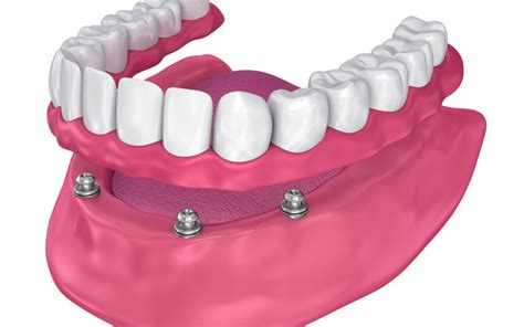 What materials are used in All-on-4 implants - Safar Medical