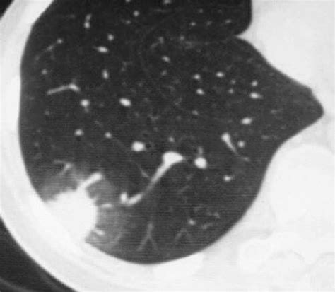 Halo Sign Halo Indicates Invasive Aspergillosis Radiology Imaging