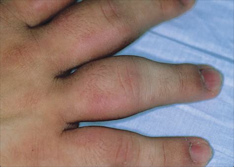 Finger Joints Swollen And Stiff At Gloria West Blog