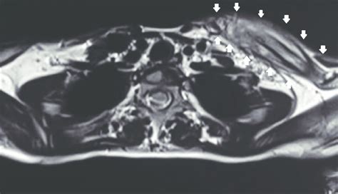 Mri T2 Weighted Axial Section Showing Heterogeneous Signal Within