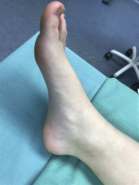 Surgery Remove Accessory Navicular Bone at Jimmy Lewis blog