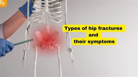 Hip Fracture Rehabilitation How Proper Rehabilitation Can Improve Your