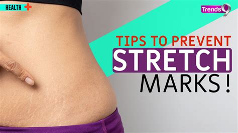 Can You Prevent Stretch Marks Stretch Marks During Pregnancy Watch