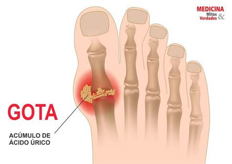 Gota No Dedão Do Pé