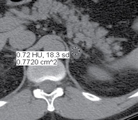 Adrenal Gland Enlargement And Nodules Clinical Tree