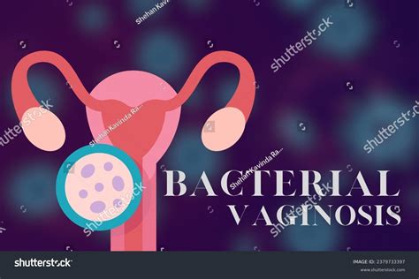 Bacterial Vaginosis Medical Illustration Depicting Condition Stock Illustration 2379733397 ...