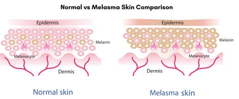 Melasma Treatment Banker Skin Smile