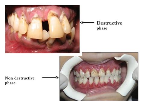 Juvenile Periodontitis