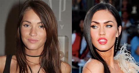 The Truth About J Plasma Learn About This Trendy Facelift Alternative