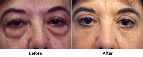 Eyelid Lift in Los Altos CA: Enhancing Your Gaze's Youthful Appeal