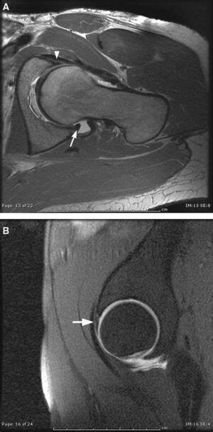 Acetabular Labrum Wikism Sports Medicine Wiki