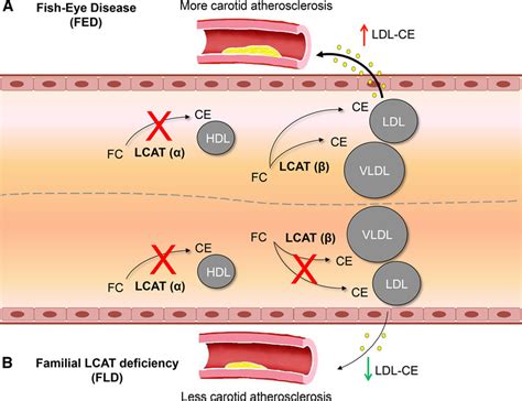 Complete And Partial Lecithin Cholesterol Acyltransferase Deficiency Is