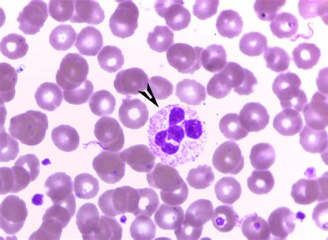 Pequeno Número De Neutrófilos No Preventivo - Neutrófilos - O que são, função, características, neutrofilia e neutropenia